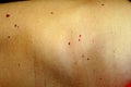 Angioma on the skin. Red moles on the body. Many birthmarks.