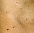 Angioma on the skin. Red moles on the body. Many birthmarks.