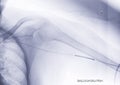 Angioplasty, balloon angioplasty and percutaneous transluminal angioplasty (PTA) on Left arm