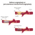 Balloon angioplasty