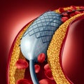 Angioplasty And Stent Concept