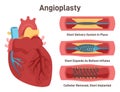 Angioplasty. Stent delivery and implantation. Deflated balloon catheter