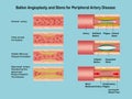 Angioplasty. Stent Implantation. Deflated balloon catheter inserted into a coronary artery narrowed by plaque. the Royalty Free Stock Photo