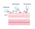 Angles for Inserting Injections vector illustration