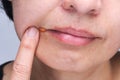 Angular cheilitis ,common inflammation of the lips Royalty Free Stock Photo