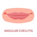 Angular cheilitis mouth corner cracks outbreak icon