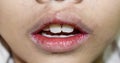 Angular stomatitis or angular cheilitis or perleche in asian little boy. Common inflammatory condition of angles of mouth