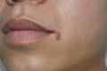 Angular stomatitis or angular cheilitis or perleche in asian man. Common inflammatory condition of angles of mouth. Caused by iron Royalty Free Stock Photo