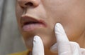 Angular stomatitis or angular cheilitis or perleche in asian man. Common inflammatory condition caused by iron, zinc or B12 Royalty Free Stock Photo