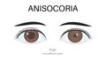 The Anisocoria eye