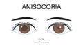 The Anisocoria eye Royalty Free Stock Photo