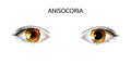 Anisocoria. pupils of different sizes