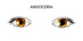 Anisocoria. pupils of different sizes Royalty Free Stock Photo