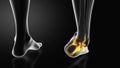 Ankle injury with dislocation and sprains