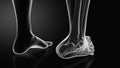 Ankle injury with dislocation and sprains