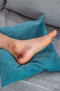 Ankle injury with dislocation and sprains. Fracture or Leg sprain injury of young sportsman.