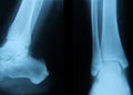 Ankle joint Royalty Free Stock Photo