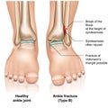 Ankle joint fracture Type B medical illustration on white background