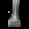 Ankle joint and lower leg x-ray image side view Royalty Free Stock Photo