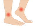 Ankle joint pain treatment