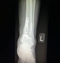 Ankle left tibia distal fracture treatment xray Royalty Free Stock Photo