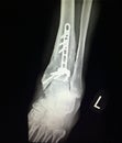 Ankle left tibia distal fracture treatment xray Royalty Free Stock Photo