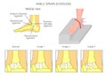 Ankle sprain.Eversion