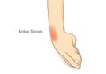 Ankle sprain and swelled. Royalty Free Stock Photo