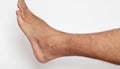 Ankle sprained and bruise contused wound on foot skin on white background.