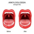 Ankyloglossia. tongue-tie. congenital oral anomaly