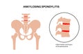 Ankylosing spondylitis disease