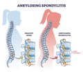 Ankylosing spondylitis as inflammatory spine bone disease outline diagram Royalty Free Stock Photo