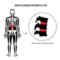Ankylosing spondylitis disease Royalty Free Stock Photo