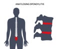 Ankylosing spondylitis disease