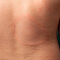 Annular erythema on the back of a child, Lyme disease