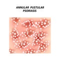 Annular pustular psoriasis. Eczema, dermatitis skin disease psoriasis. Infographics. Vector illustration on isolated