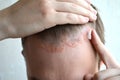 Anoint with cream, ointment, medicine forehead, hair line, scalp with psoriasis, dermatitis, problem skin, eczema Royalty Free Stock Photo