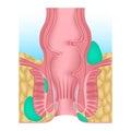 Anorectal abscess. Swelling near the anus. Inflammation of the anus and rectum