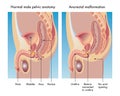 Anorectal Malformation Illustration Royalty Free Stock Photo