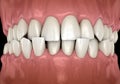 Anterior crossbite dental occlusion Malocclusion of teeth . Medically accurate tooth 3D illustration