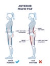 Anterior pelvic tilt or APT as pelvis abnormal posture outline diagram