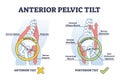 Anterior pelvic tilt model compared with posterior in labeled outline diagram Royalty Free Stock Photo