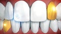 Anterior teeth with gemstone implant and eyeteeth in gold