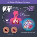 Anthrax effects on humans it can cause death