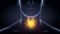 Antibodies attacking thyroid gland of a man, Autoimmune thyroiditis, Hashimoto`s disease