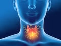 Antibodies attacking thyroid gland of a woman,  Autoimmune thyroiditis, Hashimoto`s disease Royalty Free Stock Photo