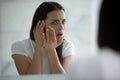 Anxious girl teenager troubled by bad condition of facial skin