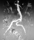 Aoritogram with mesenteric and iliac embolization coils