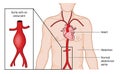 Aortic aneurysm