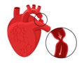 Aortic coarctation - narrowing illustration